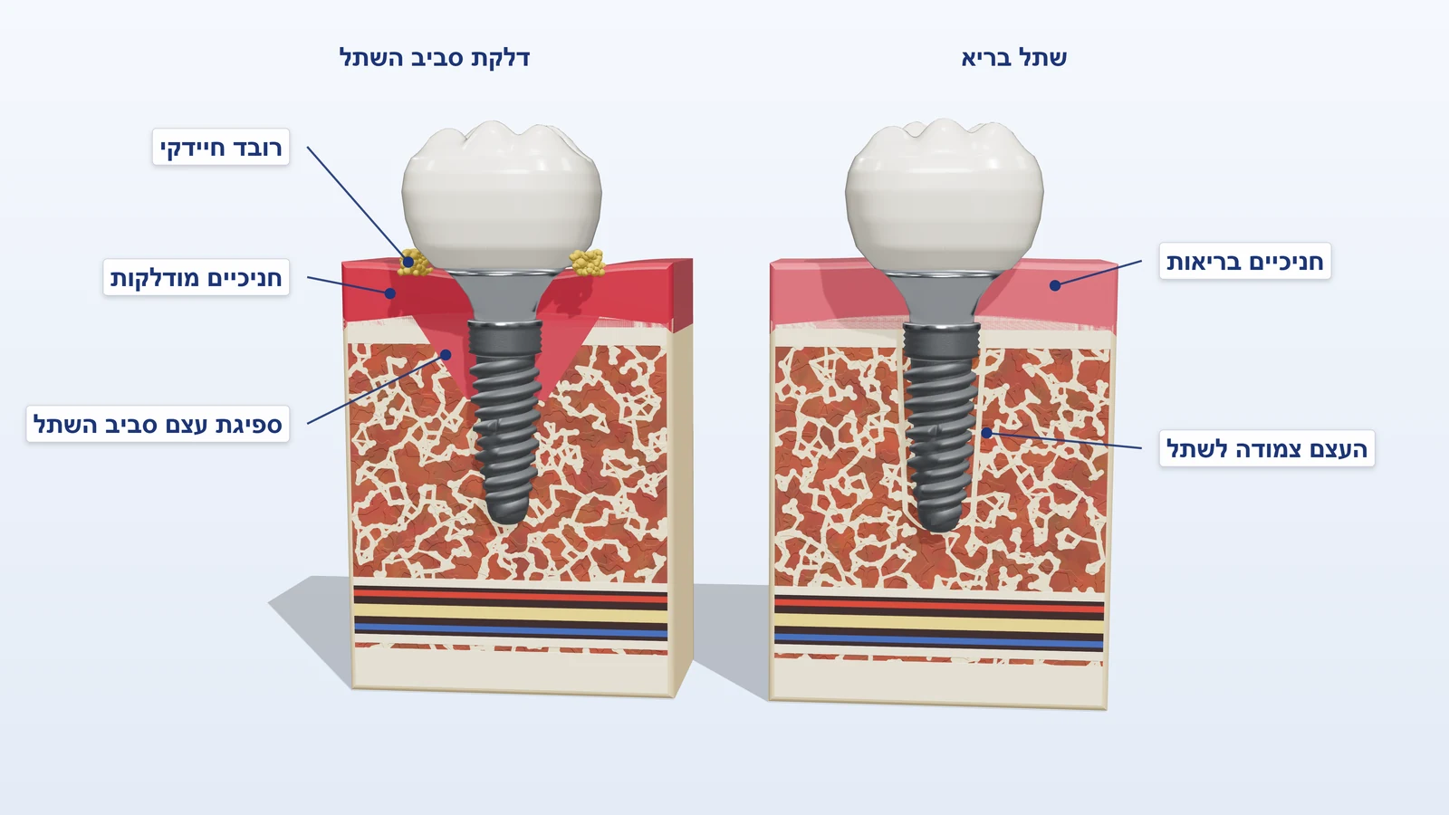 איור תלת-ממדי: שתל בריא מול שתל עם דלקת, חניכיים מודלקות, רובד וספיגת עצם סביב ההברגות
