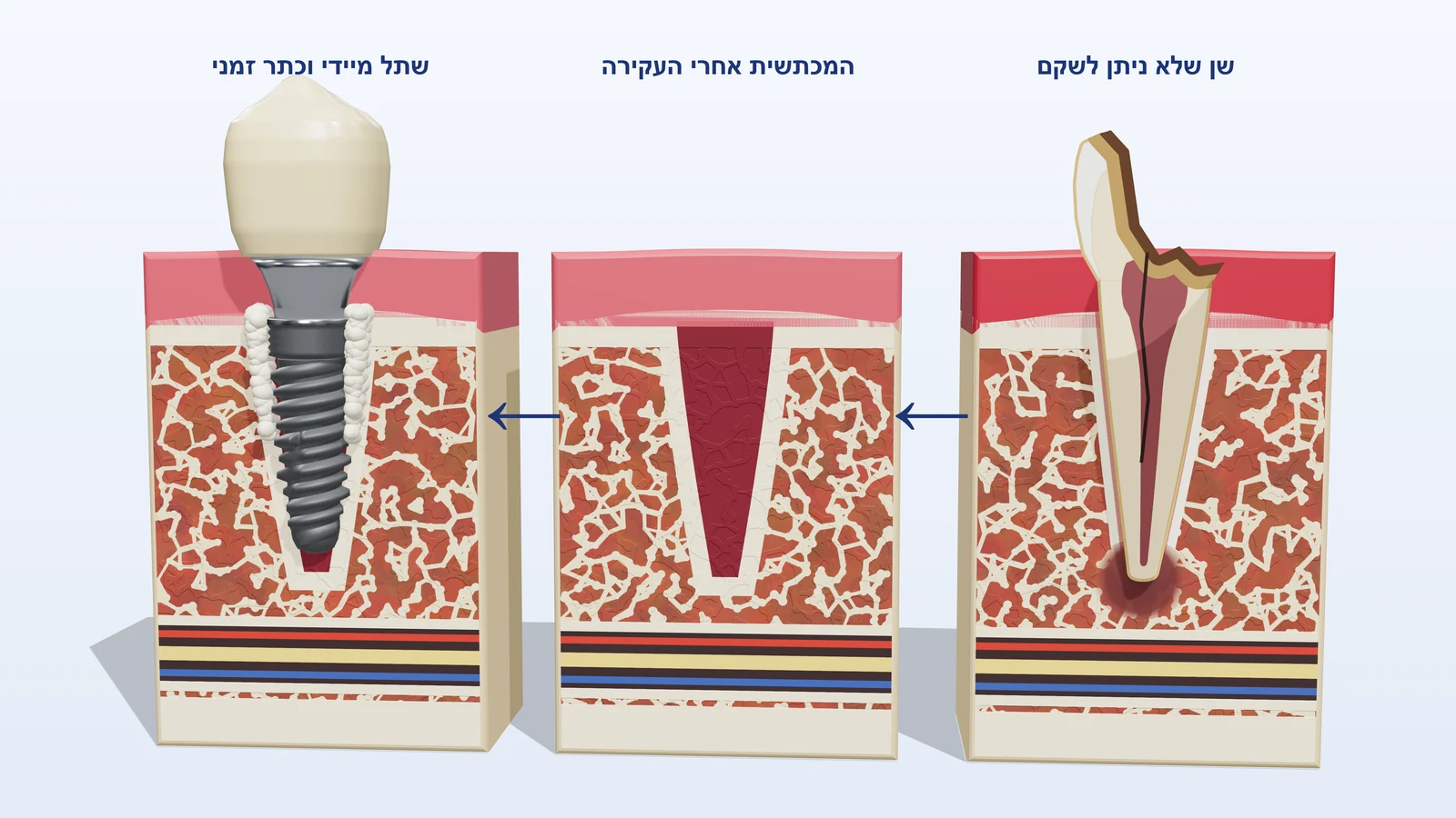 איור תלת-ממדי בשלושה שלבים: שן שלא ניתן לשקם, המכתשית אחרי העקירה, ושתל מיידי עם כתר זמני