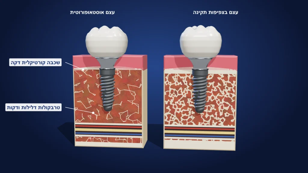 איור תלת-ממדי: השוואה בין עצם בצפיפות תקינה לעצם אוסטאופורוטית סביב שתל