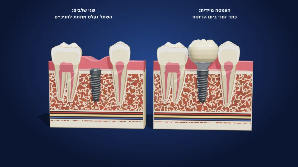 איור תלת-ממדי: שתל עם כתר זמני ביום הניתוח מול שתל שנקלט מתחת לחניכיים
