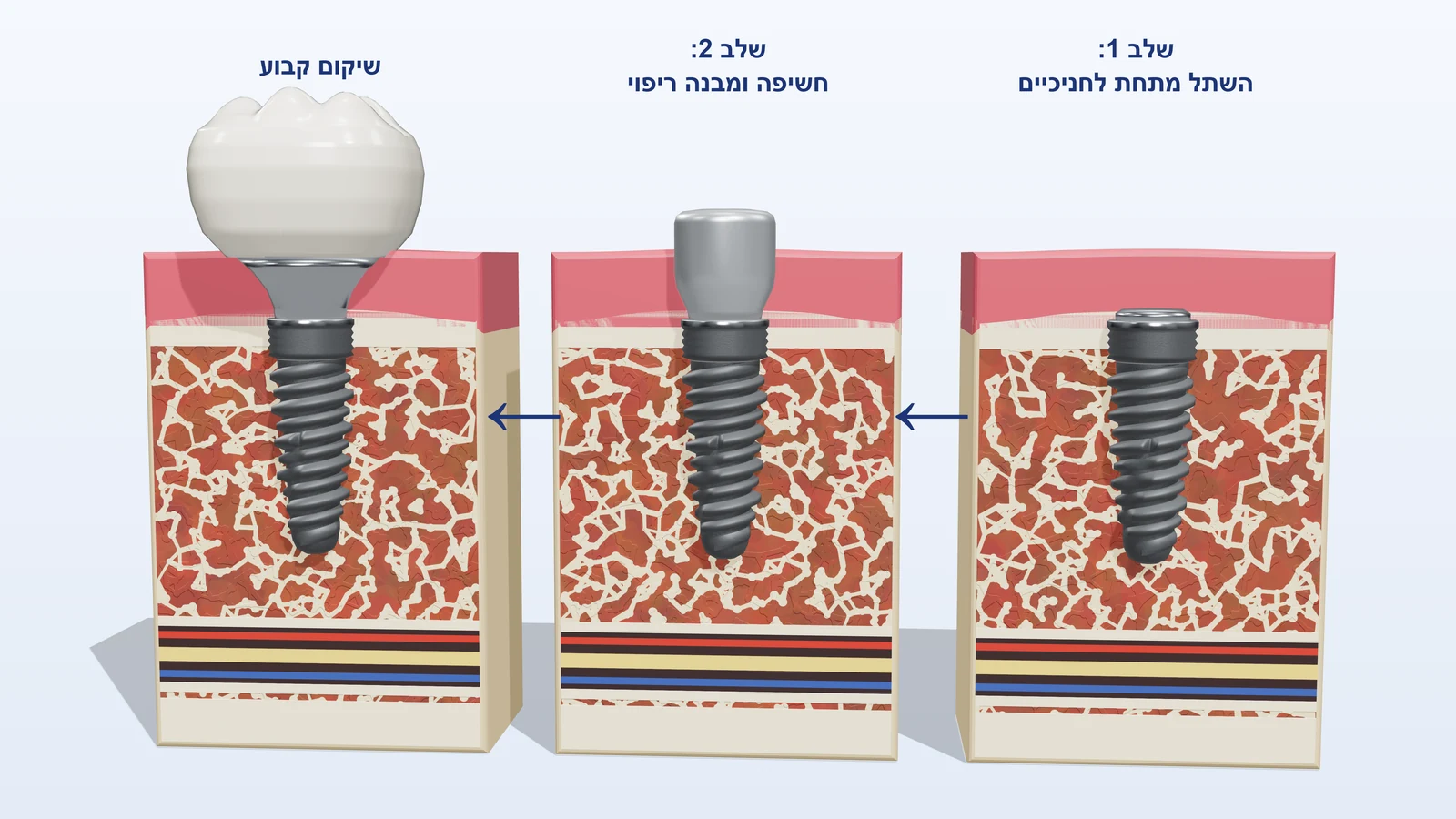 איור תלת-ממדי: שלבי ההשתלה בשני שלבים, מהשתל מתחת לחניכיים, דרך מבנה ריפוי, ועד השיקום הקבוע